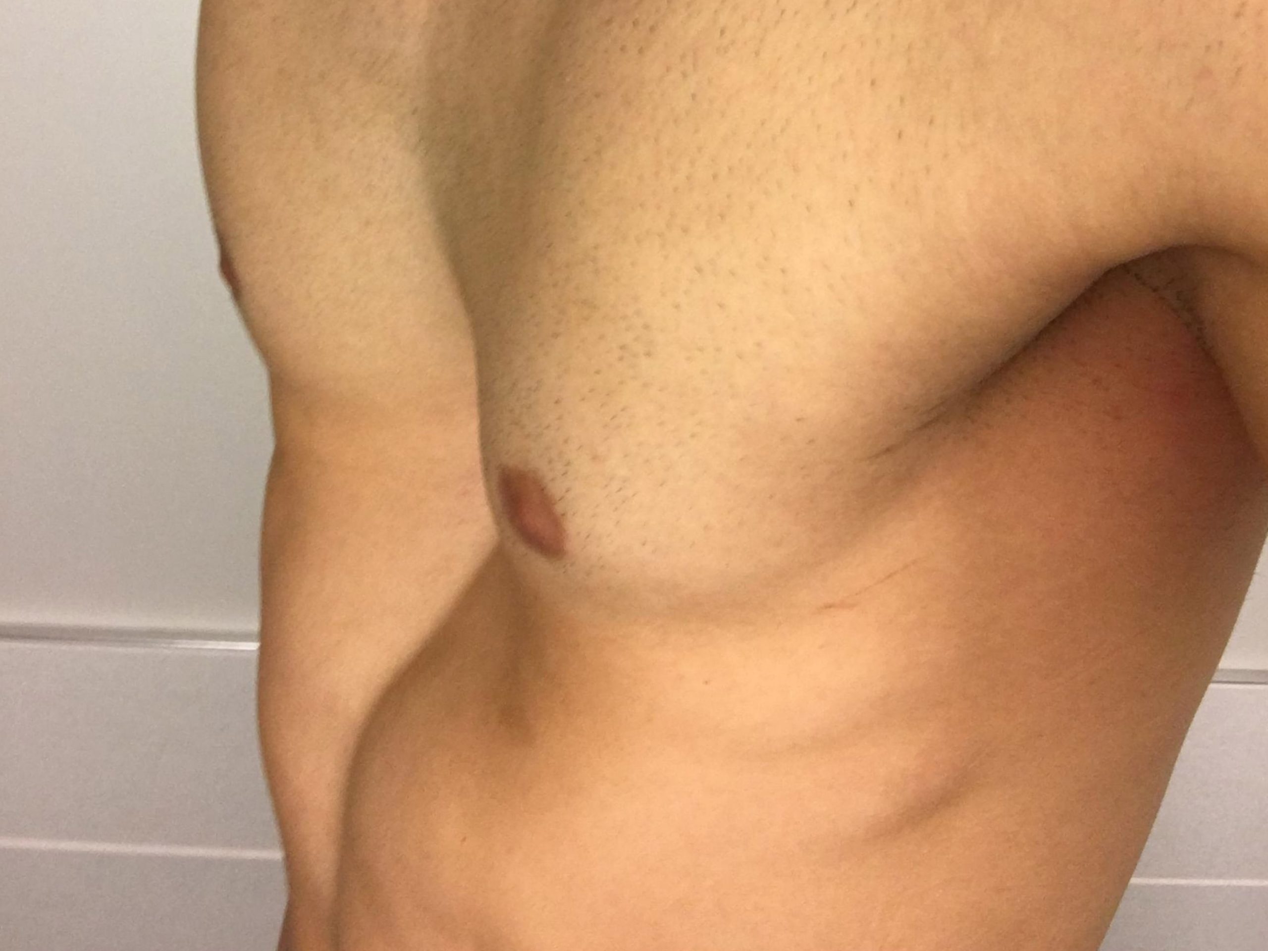 Preguntas habituales sobre Pectus carinatum-Pectus-excavatum