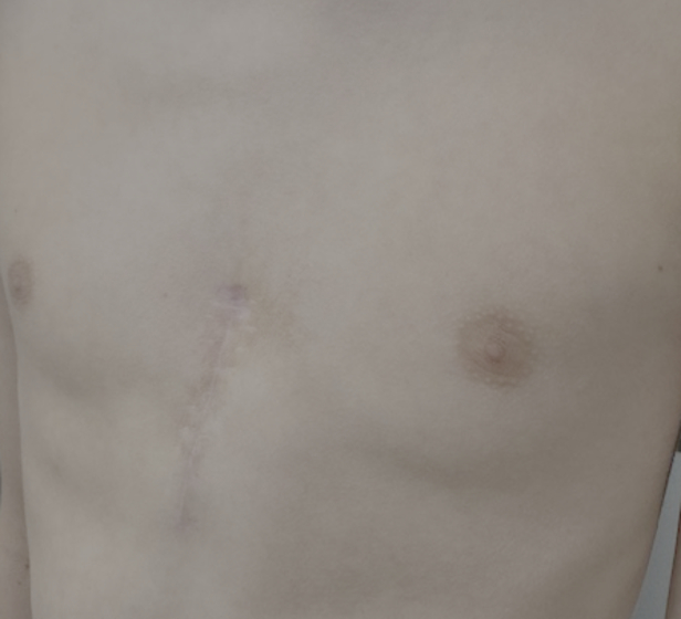 6º mes tras cirugía y retirada definitiva de chaleco - Pectus Carinatum asimétrico