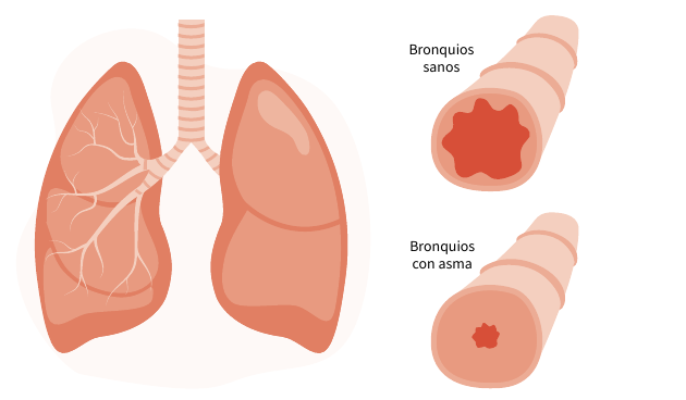 Comparativa de bronquio sano frente a bronquio con asma e inflamación