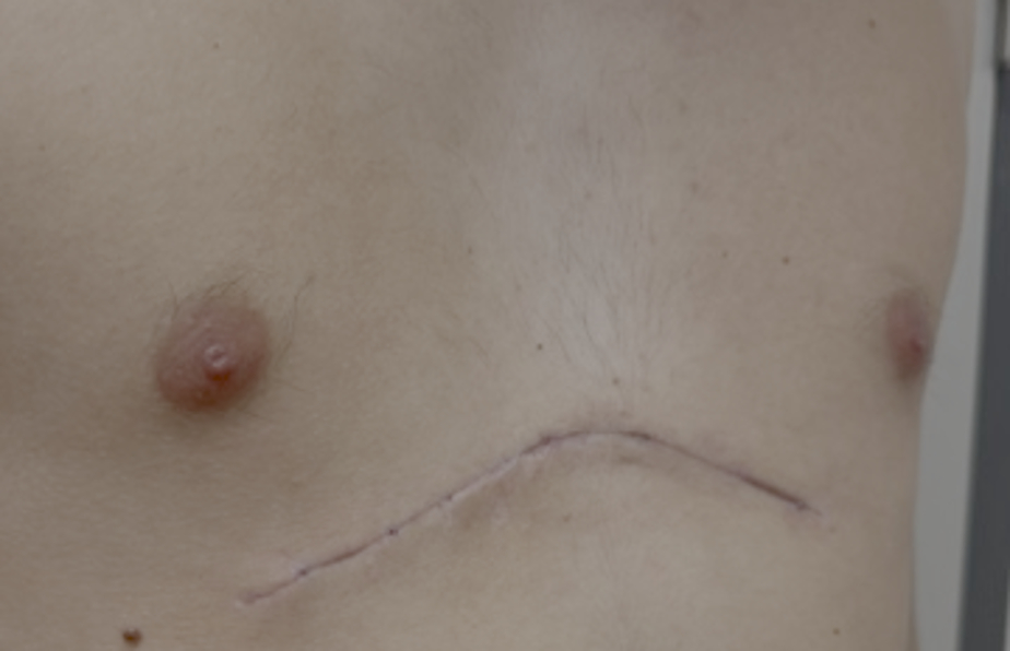 2º semana de la cirugía - Pectus Excavatum Grave varón 19 años